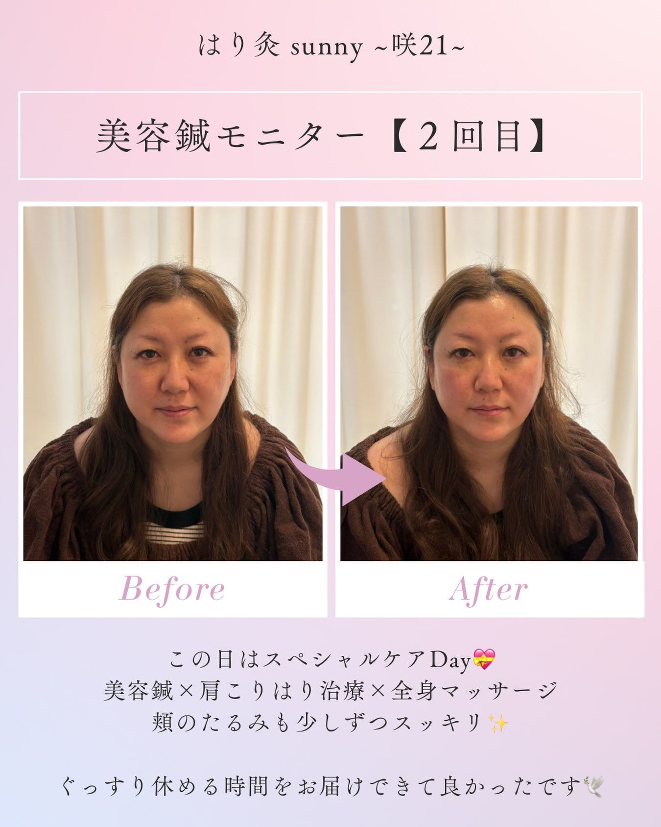 🌟 美容鍼モニター 【 2回目 】 🌟