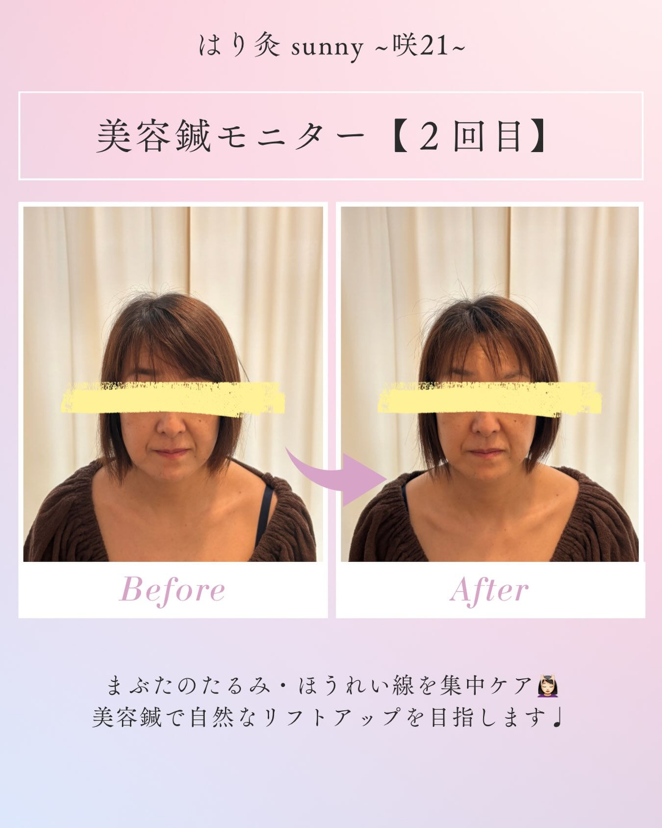 🫧 美容鍼モニター 【2回目】 🫧