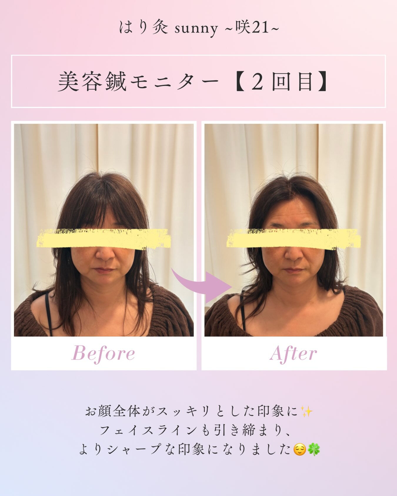🌼 美容鍼モニター【2回目】 🌼