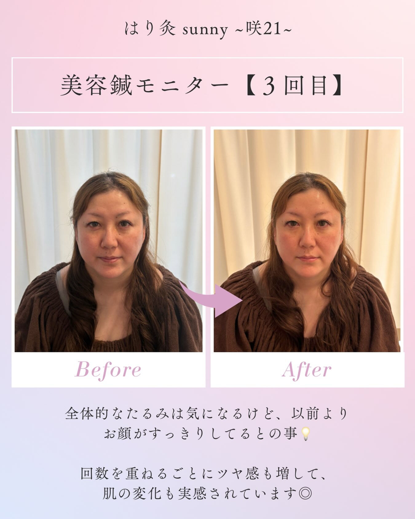 🌟 美容鍼モニター 【 3回目 】 🌟