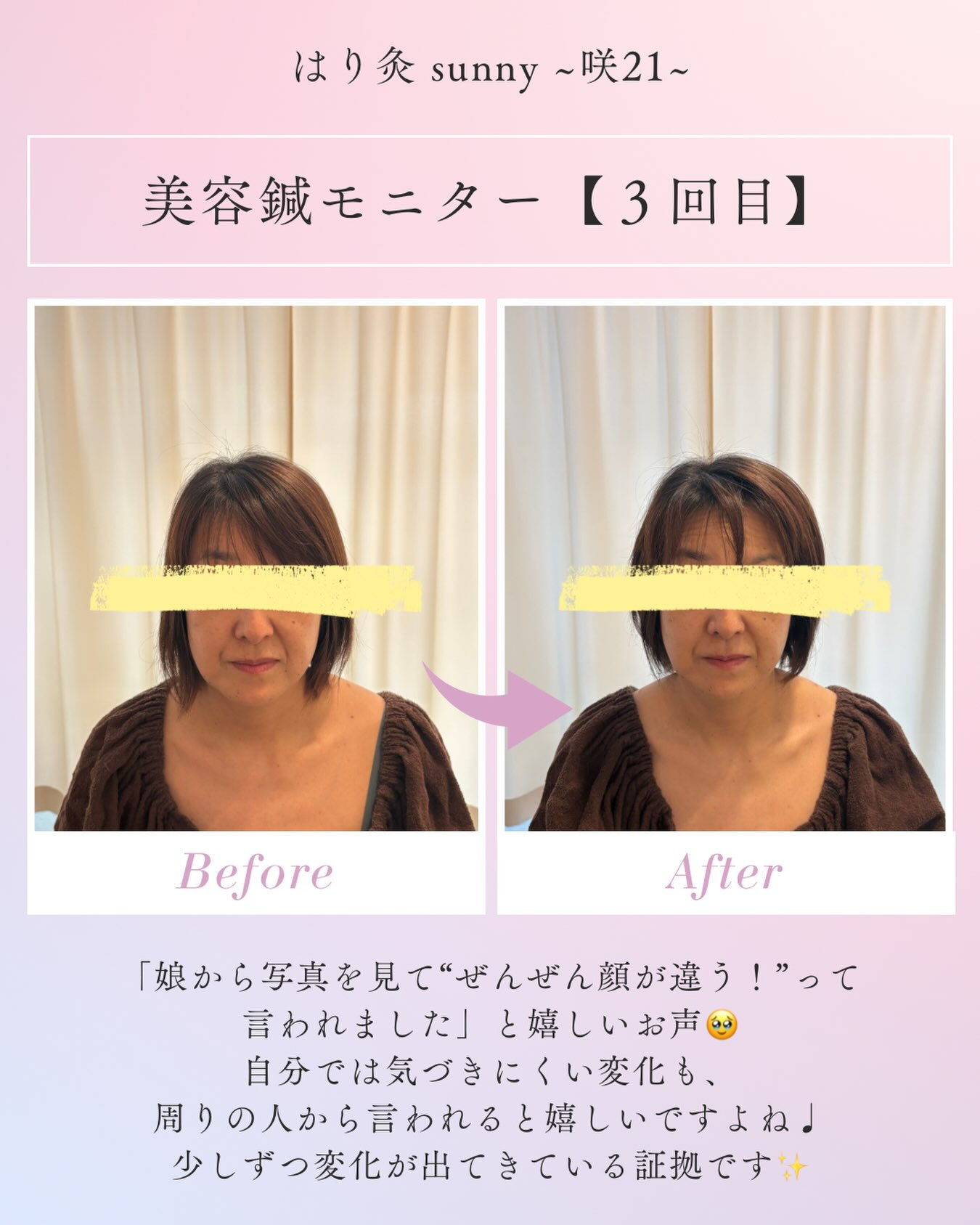 🫧 美容鍼モニター 【3回目】 🫧