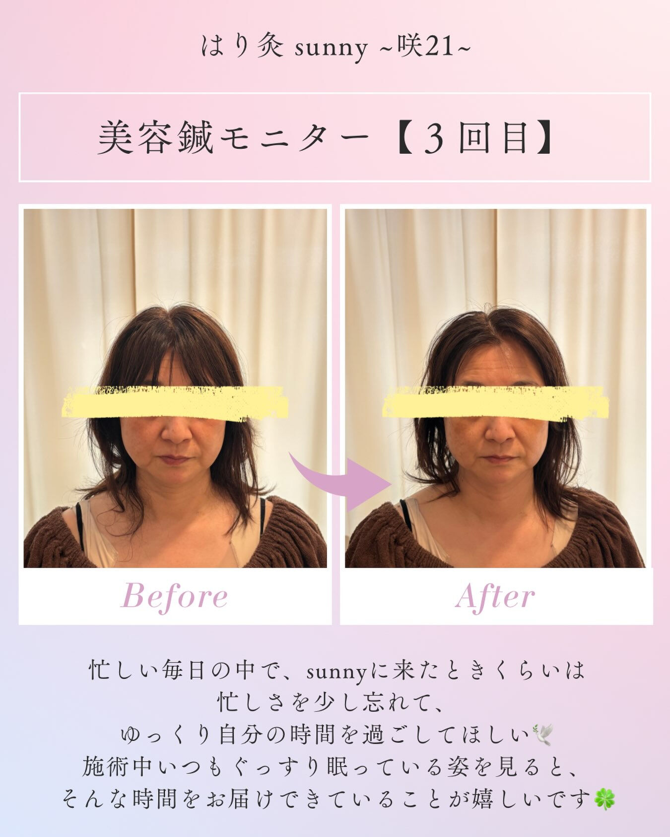 🌼 美容鍼モニター 【3回目】 🌼