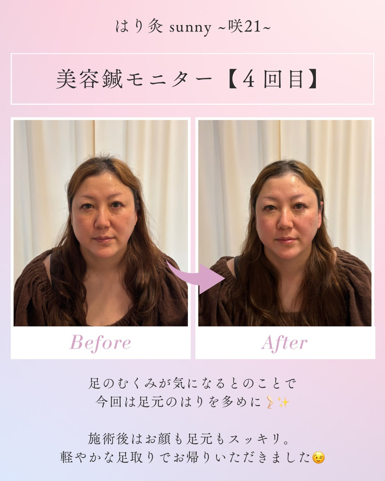 🌟 美容鍼モニター 【4回目】 🌟