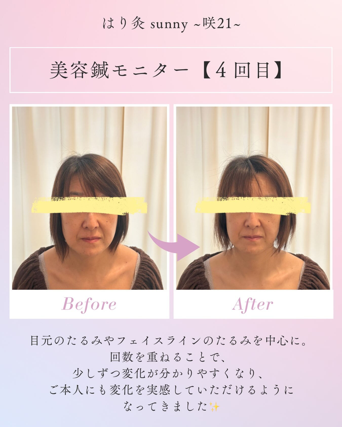 🫧 美容鍼モニター【４回目】🫧