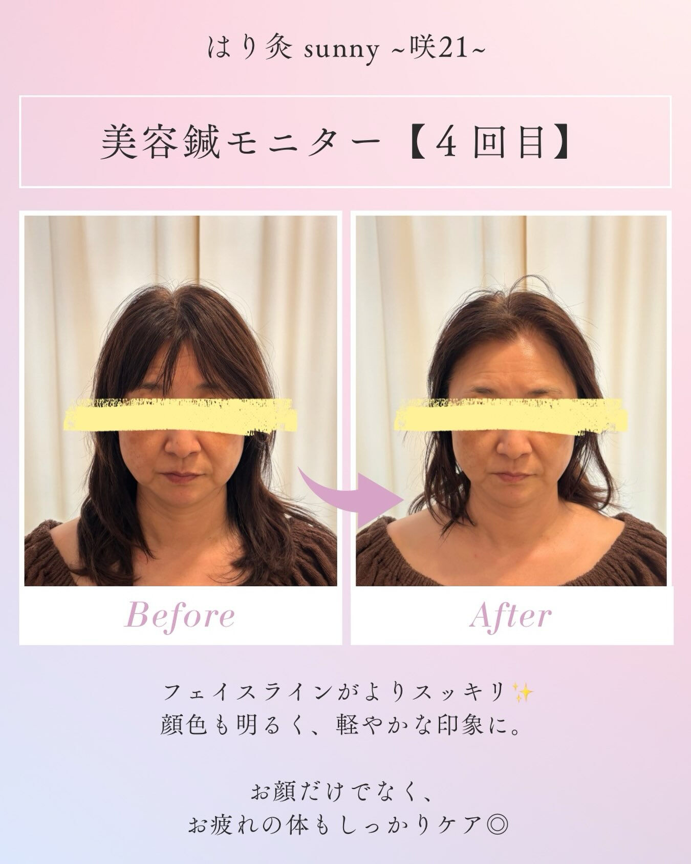 🌼 美容鍼モニター【4回目】 🌼