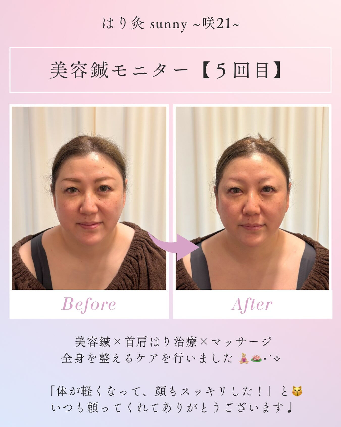 🌟 美容鍼モニター 【5回目】 🌟