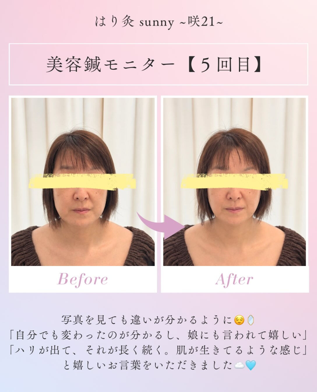 🫧美容鍼モニター 【5回目】🫧