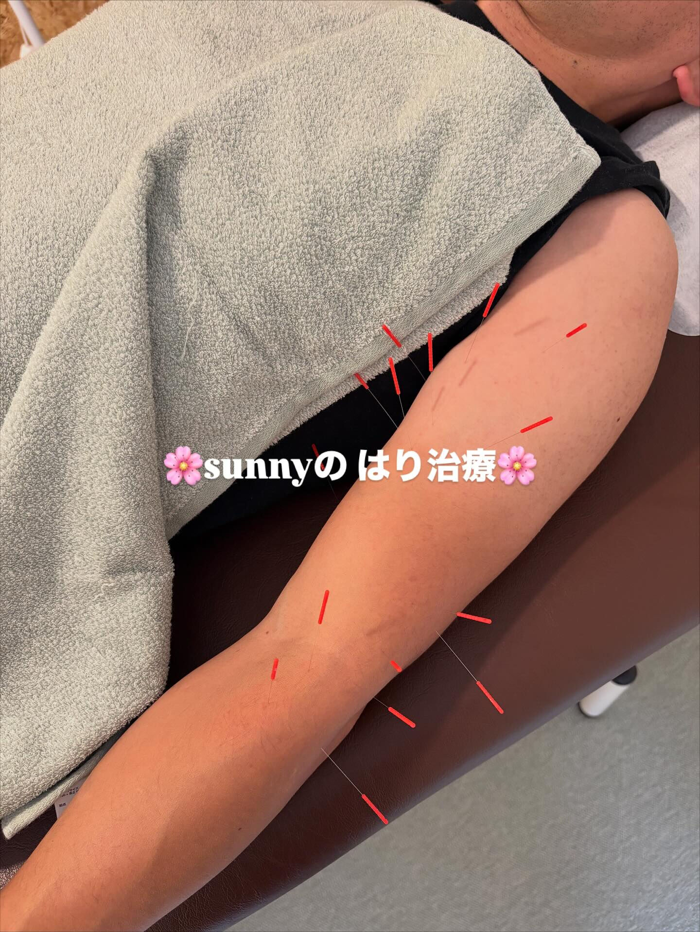 🦔肘の痛みで来てくれた方のはり治療🦔