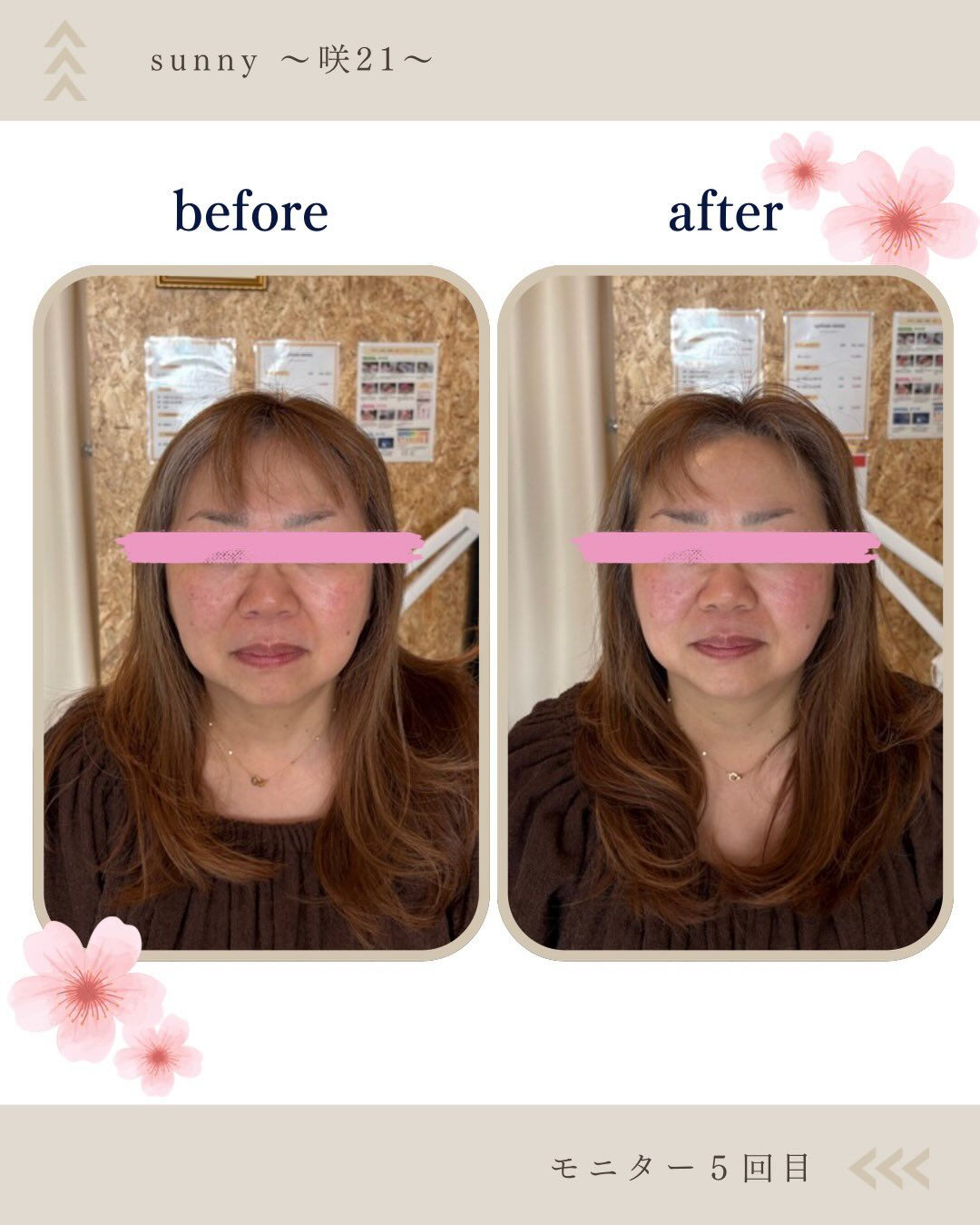 【美容鍼モニターさま 50代 5回目】