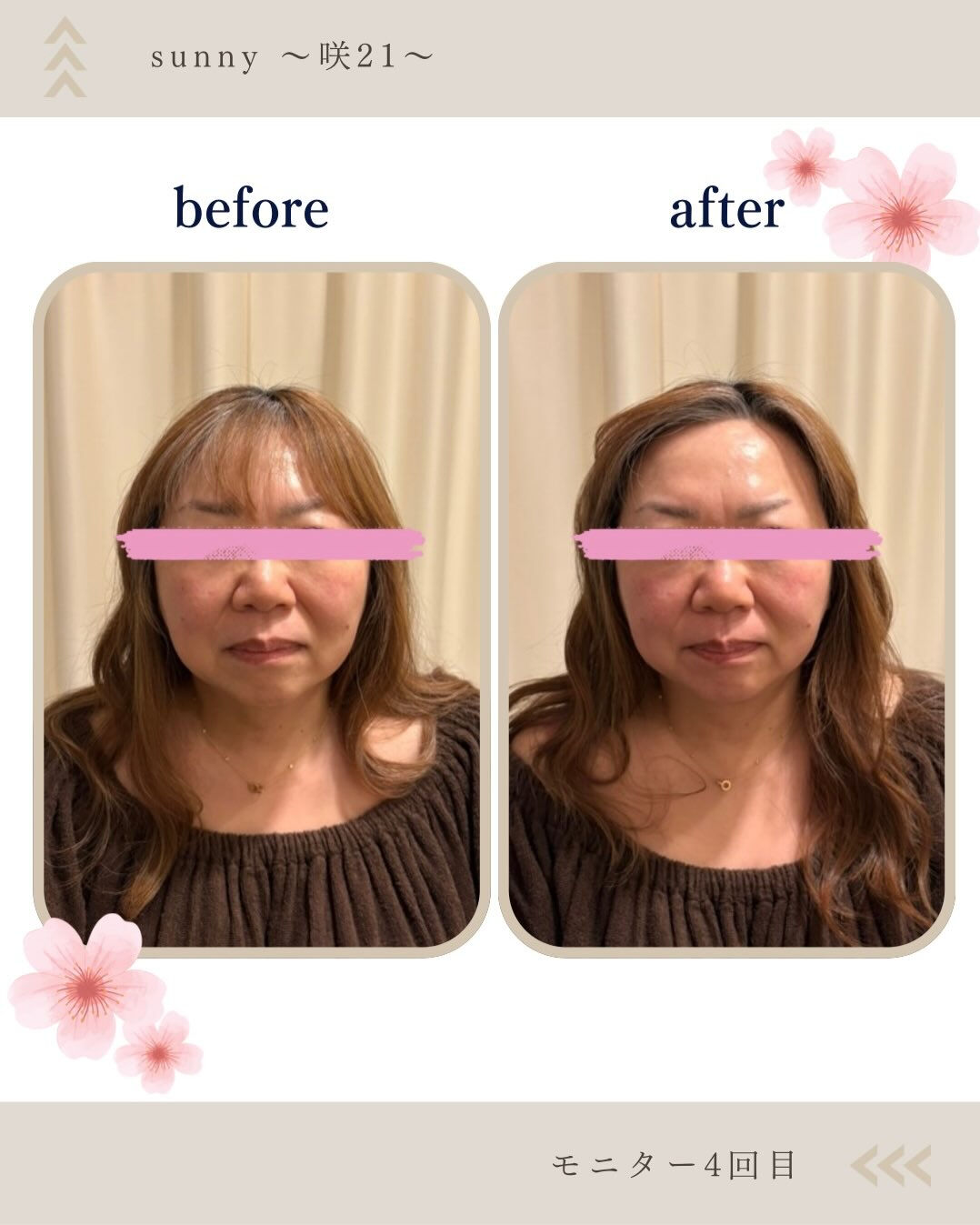 【美容鍼モニターさま 50代 5回目】