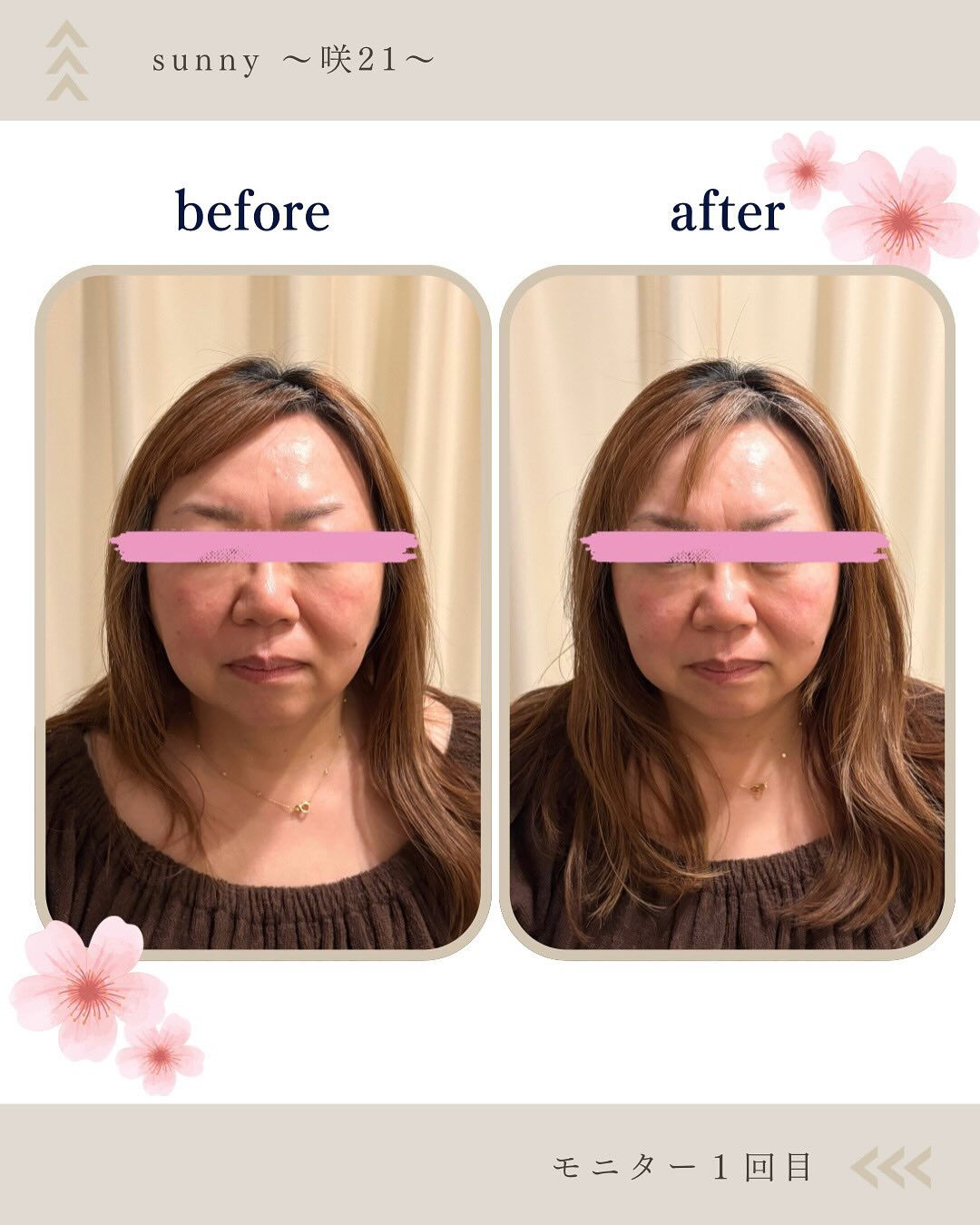 【美容鍼モニターさま 50代 5回目】