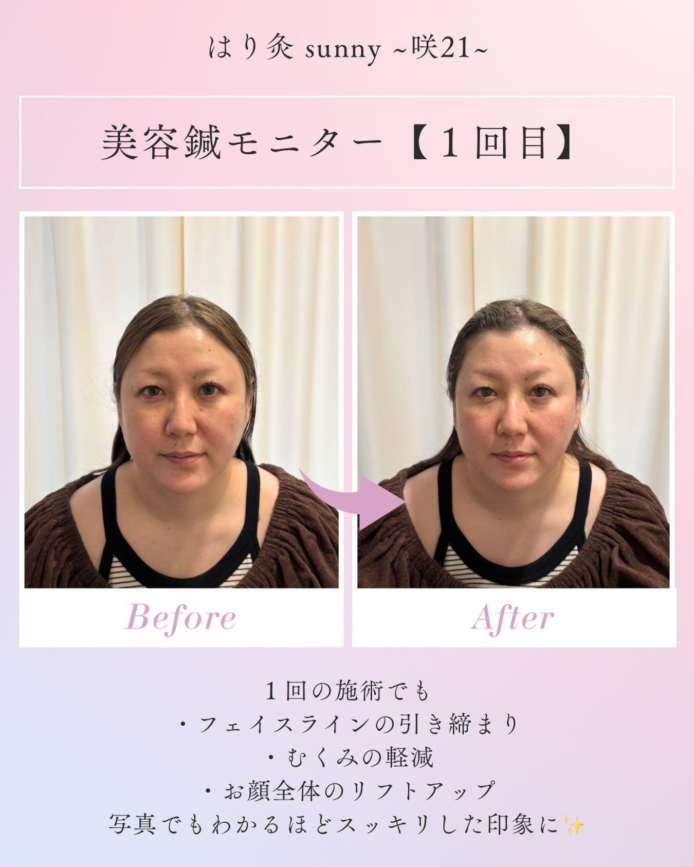 🌟 美容鍼モニター 【 1回目 】 🌟
