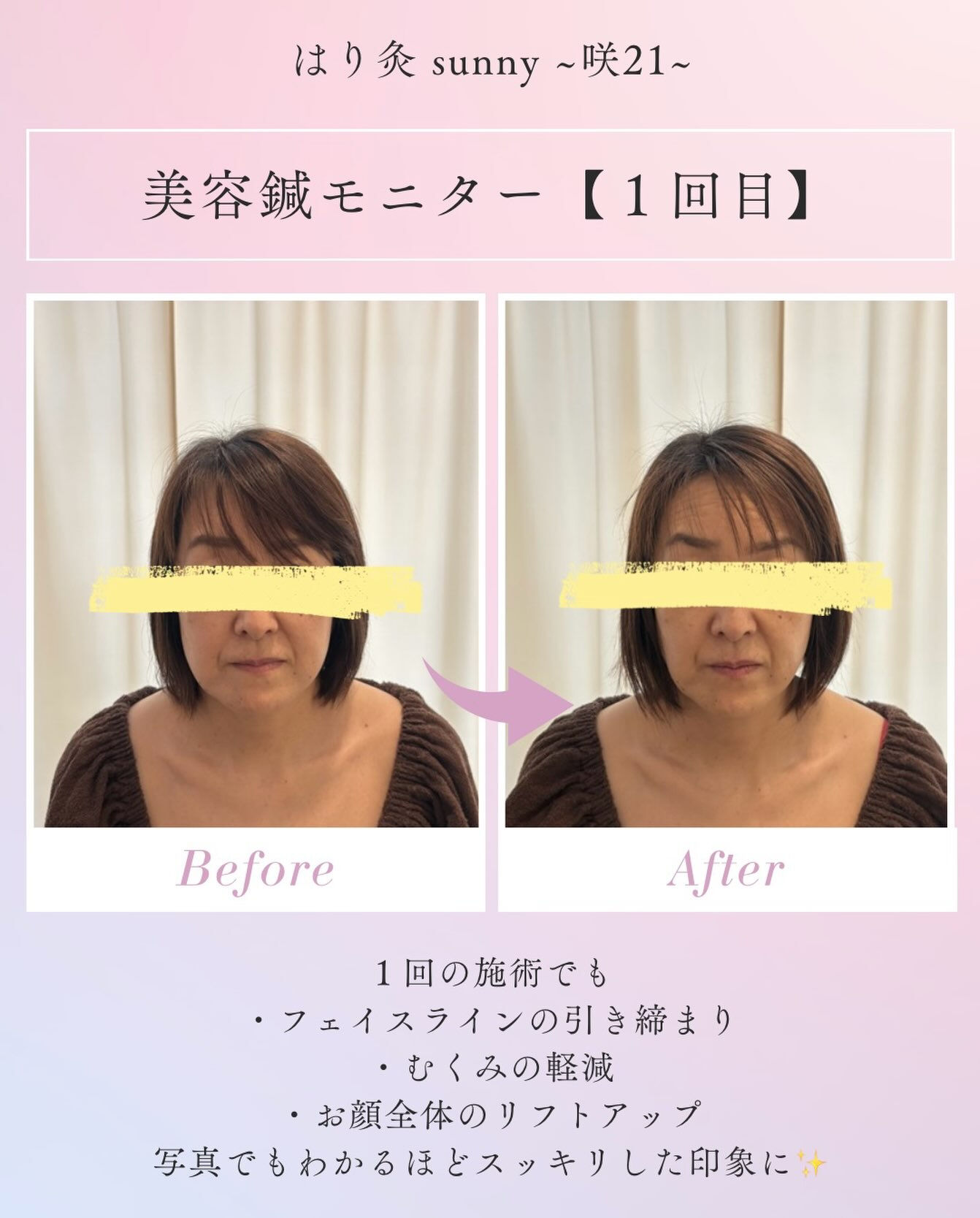 🫧 美容鍼モニター【1回目】 🫧
