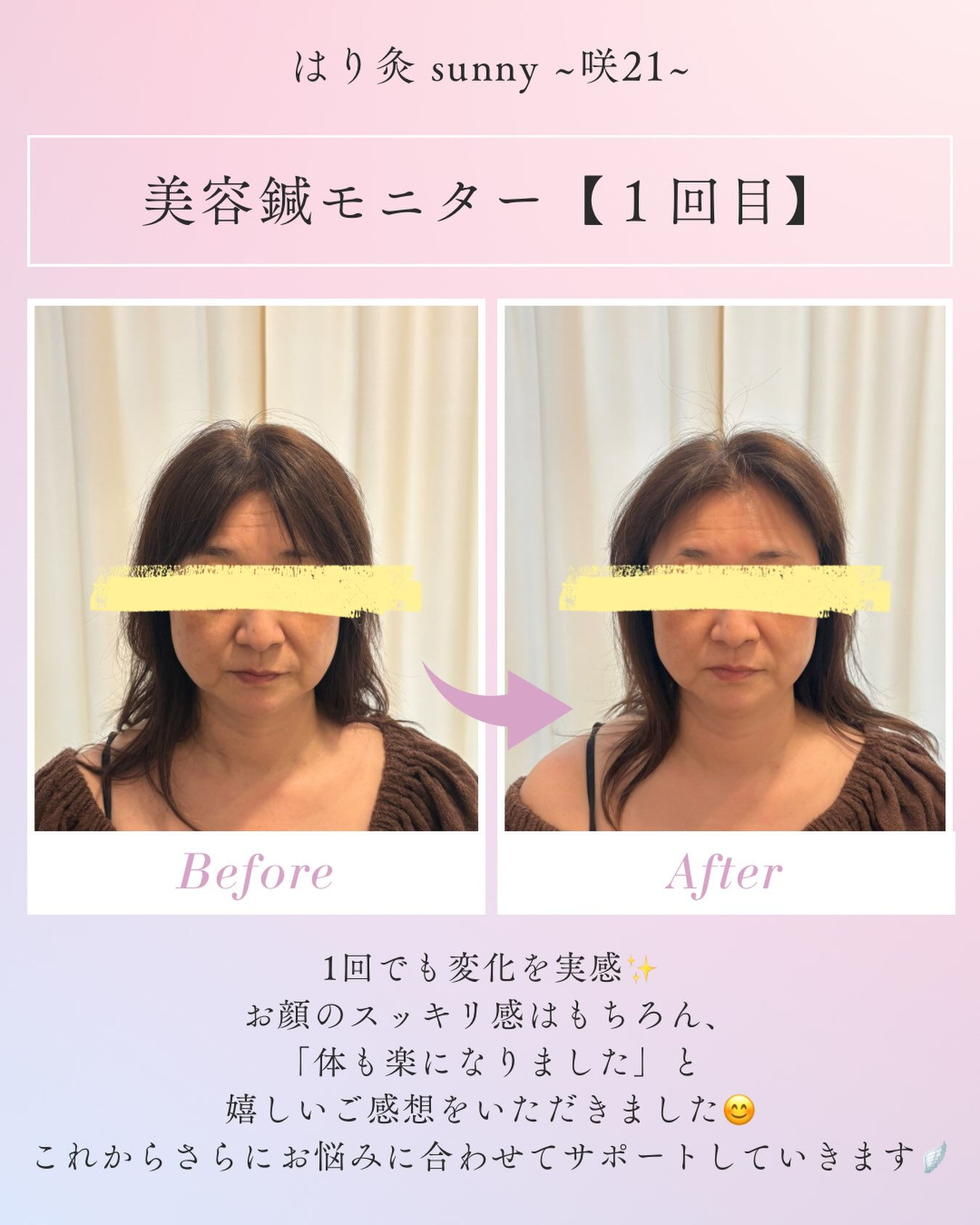🌼美容鍼モニター【1回目】🌼